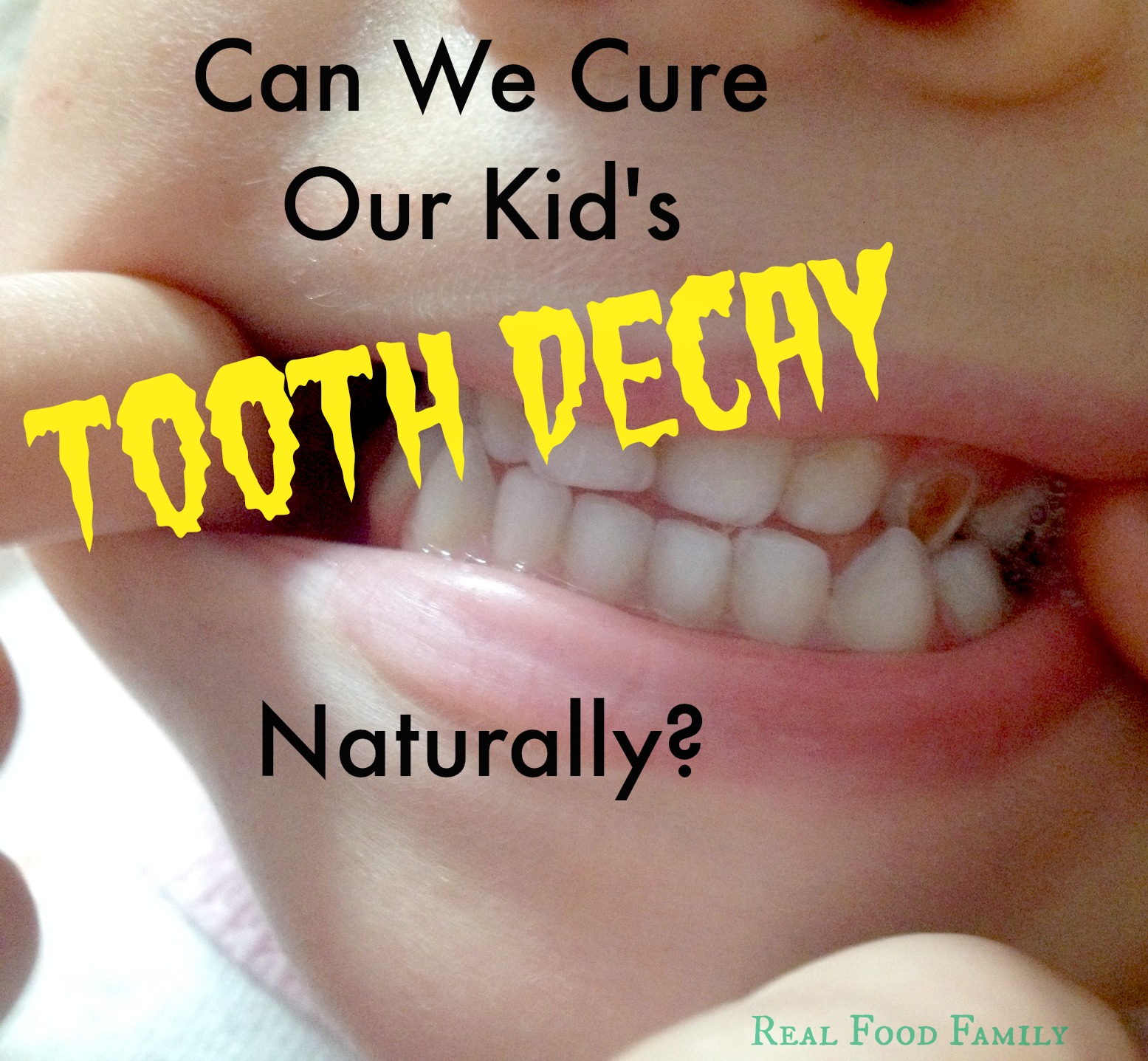 Can We Cure Our Kid’s Tooth Decay Naturally?